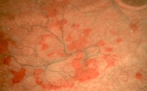 Pathology Outlines - Malakoplakia