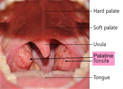 Sore Throat Diagram