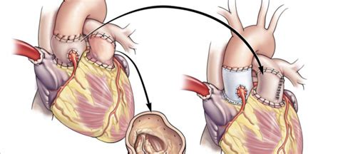 Ross procedure | Cardiac Surgeon | Dr. Antonios Pitsis