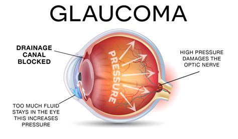 Glaucoma Treatment - PghEyeMeds