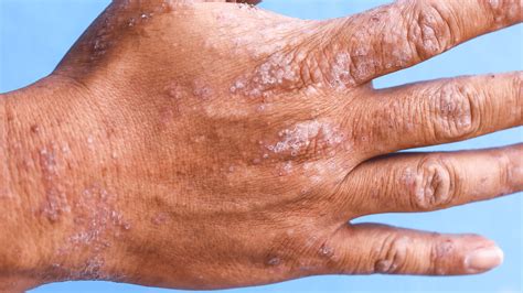 Eczema Is Making Me Miss Work Online | jkuat.ac.ke