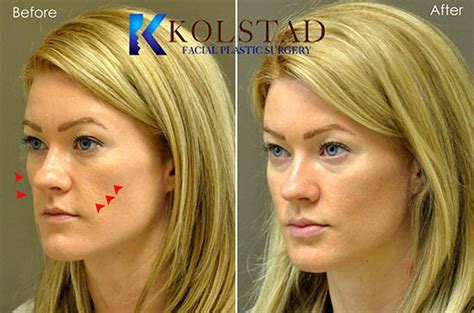 Cheek Fillers & Smile Line Fillers Results | Dr. Kolstad - San Diego Facial Plastic Surgeon