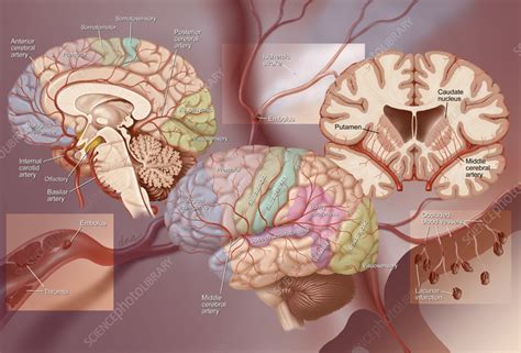 Anatomy of ischemic stroke, illustration - Stock Image - C057/3375 ...