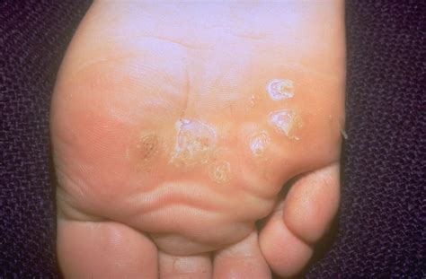 Types of Warts and How to Treat Them - A Visual Guide | Allure