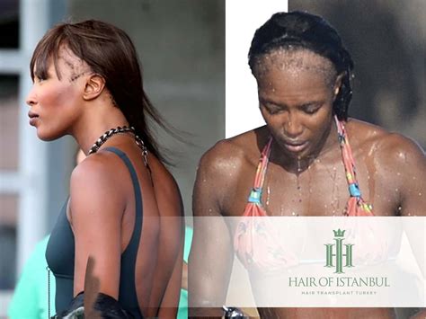 Naomi Campbell Hair Loss: Facing the Reality of Bald Patches