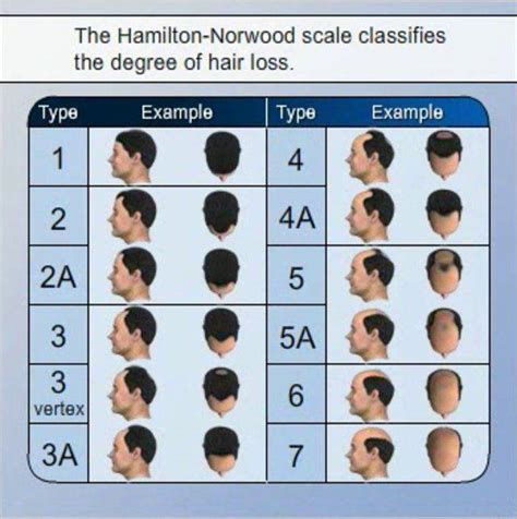 Hamilton Norwood Scale - Measure Hair Loss WIth Hamilton Norwood