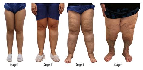 Lipedema: What is it, and how is it treated?