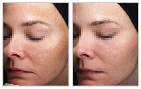 Tips For Taking The Best Before-And-After Photos Of Your Skin-Resurfacing Patients — Sciton Blog