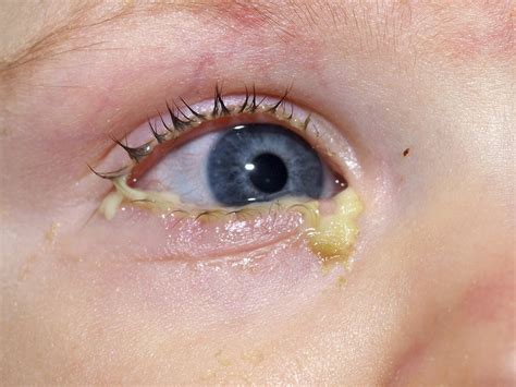 Virale Konjunktivitis - Conjunctivitis in Babies: Causes, Symptoms and Treatment ...