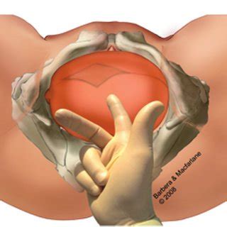 (PDF) Asynclitism: A literature review of an often forgotten clinical condition