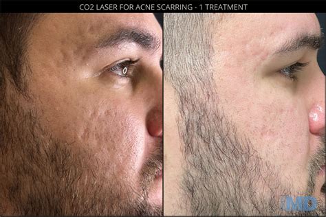 CO2RE® Laser Resurfacing | Boston - Skin MD