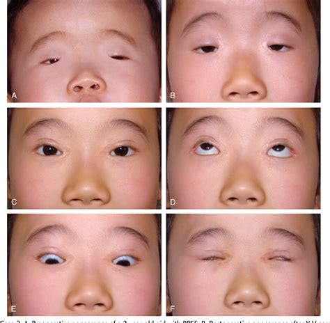 Blepharophimosis Ptosis Epicanthus Inversus Syndrome Or Bpes