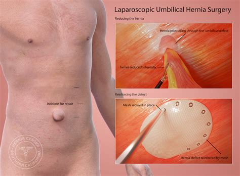 How To Fix Umbilical Hernia - Braincycle1