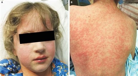 Amoxicillin Rash in Infectious Mononucleosis | NEJM