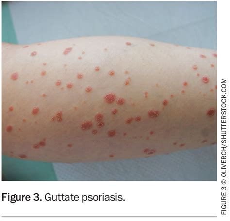 Psoriasis In Children: Symptoms, Types How To Deal With It, 46% OFF