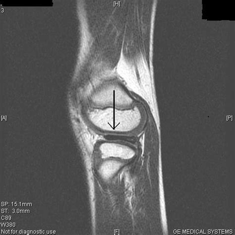 Discoid Lateral Meniscus-MRI - Sumer's Radiology Blog