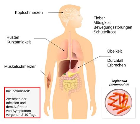 Legionellen Symptome Die typischen Anzeichen der Legionärskrankheit