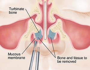 Nasal Surgery: Turbinate Surgery | Saint Luke's Health System