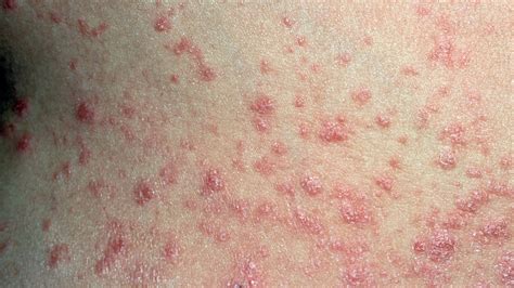 What Is Psoriasis? Symptoms, Causes, Diagnosis, Treatment, and Prevention