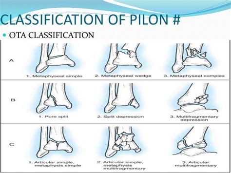 Pilon fractures