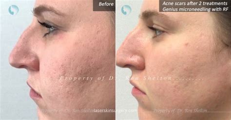 Acne Scar Treatment Chicago, IL Anil Shah, MD Dermatology | lupon.gov.ph