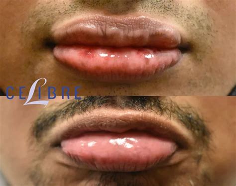 Lips Spots Removal : Dark And Sun Spots On Lips