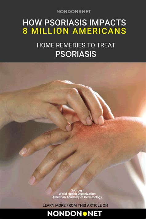 9 Herbs and Home Remedies to Treat Psoriasis Naturally