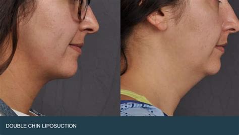 Double Chin Surgery Liposuction Phoenix | Phoenix Liposuction