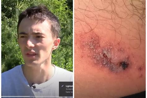 Michigan Teen Suffers From Recluse Spider Bite [VIDEO]