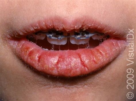 Causes Of Dry Bleeding Lips - Infoupdate.org
