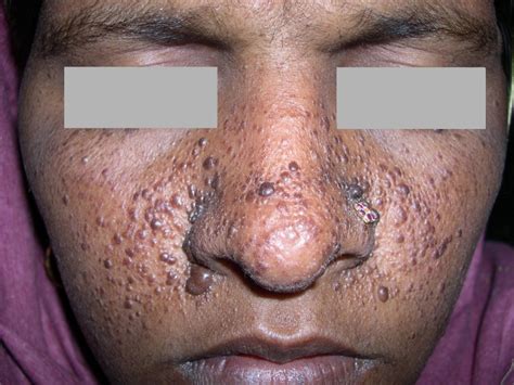 Tuberous sclerosis - Symptoms, Causes, Pictures, Treatment, Diagnosis | HealthMD