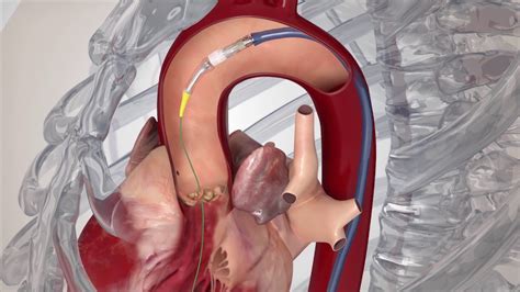 Transcatheter Aortic Valve Replacement (TAVR) for Aortic Stenosis - YouTube