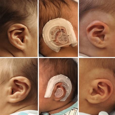 Earwell Newborn Ear Molding | Summit, NJ