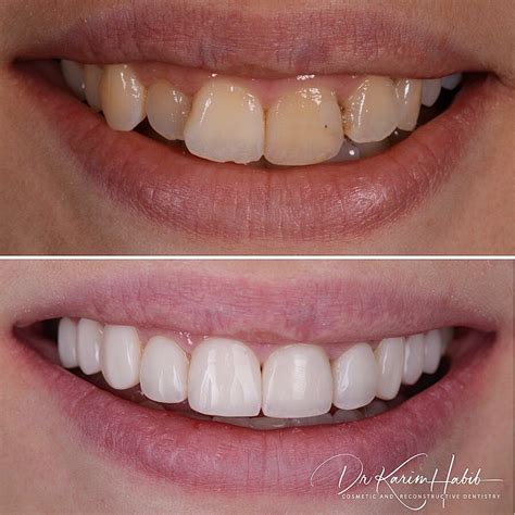 Teeth Veneers Before And After