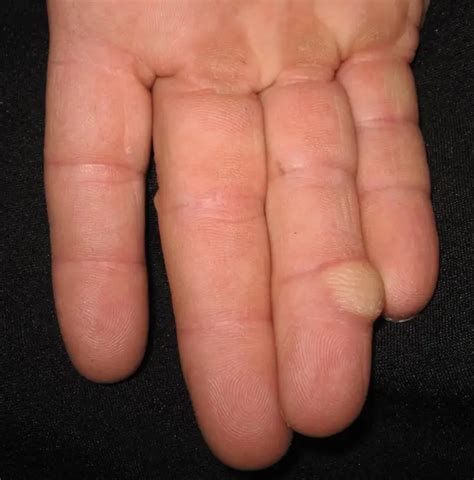 Finger cancer: photos, symptoms and treatment | Cancer 2024