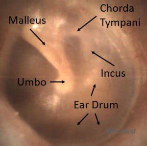 Normal Ear Drum Anatomy - WiscMed