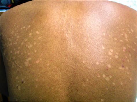 Pityriasis versicolor, causes, symptoms, diagnosis, treatment & prognosis