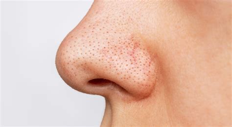 Nose Blackheads: Tips on How to Get Rid of Them | Healthnews