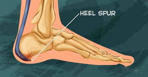 Heel Spur: Symptoms, Risk Factors, And How To Relieve The Pain - us.abrozzi.com