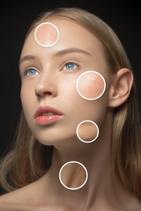 10 Common Myths About Acne - ReliableRxPharmacy Blog, Health Blog