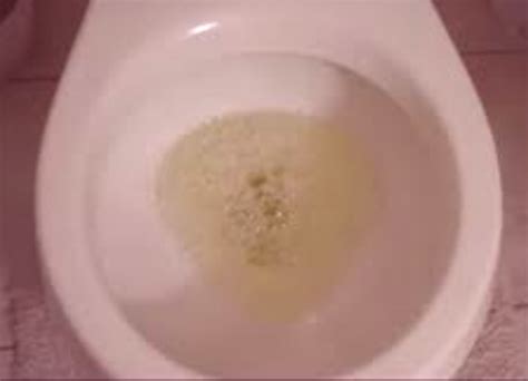 Bubbles in Urine - Pictures, Causes, Symptoms, Treatment