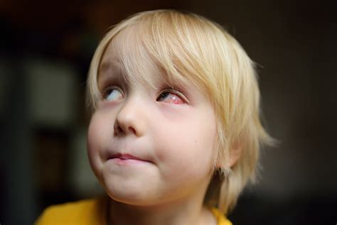Signs You May Have Pink Eye | Skowron Eye Care