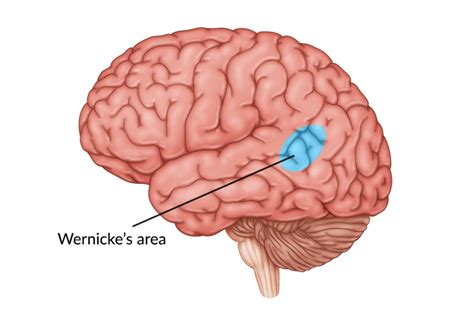 Damage to Wernicke's Area: Symptoms & Recovery