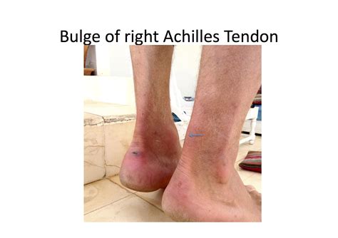 Achilles Tendinopathy | Private GP and Wellness Clinic Belfast