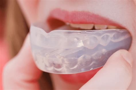 Mouth Guards For Bruxism - Burwood Dental Care