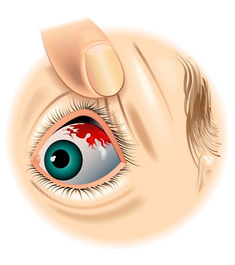 7 Causes of a Red Spot on Your Eye (And How to Treat Them)