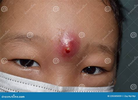 Carbuncle or Abscess at Forehead Stock Image - Image of sore, acne: 235305059