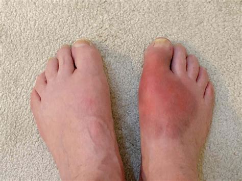 Pictures of Arthritis in the Feet: Signs, Symptoms, and Risk Factors