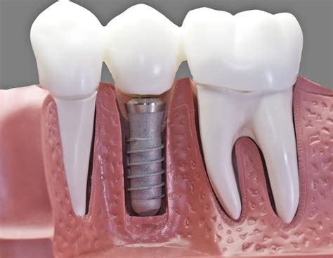 Are Dental Implants Permanent? - American Society of Implant and Reconstructive Dentistry