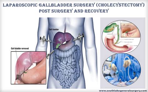 Gallbladder Post-surgery effects and Recovery - Southlake General Surgery